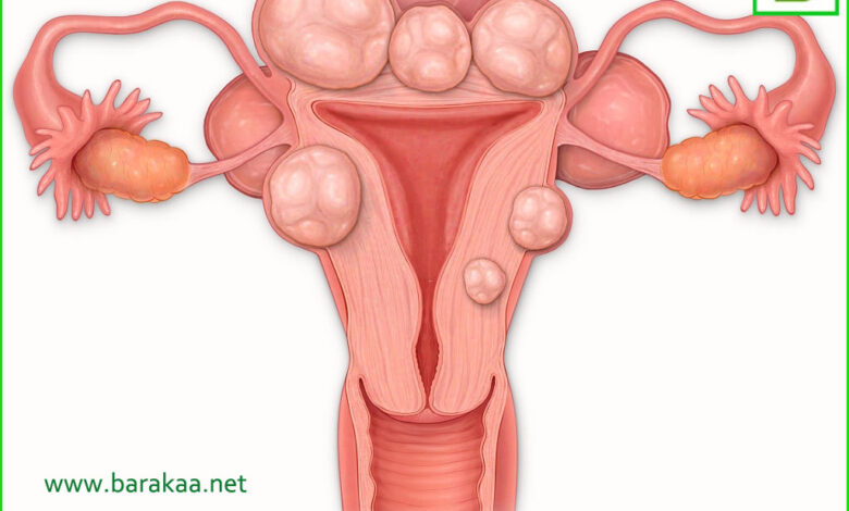 علاج التهاب المهبل بالاعشاب بزيت الزيتون تخلص من التهاب المهبل نهائيا بركة للأعشاب الطبية