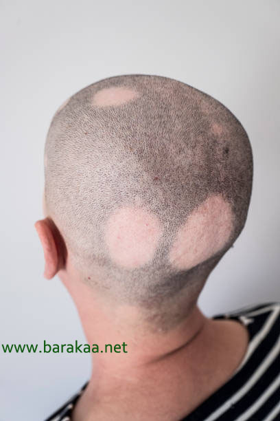 علاج الثعلبة بالاعشاب تخلص من مرض الثعلبة نهائيا وتمتع بمظهر جميل وجذاب