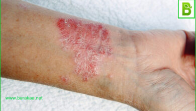 علاج التهابات الجلد بالاعشاب