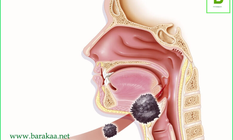 علاج سرطان الحنجرة بالاعشاب