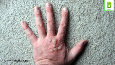 علاج الفقاعات الجلدية بالاعشاب