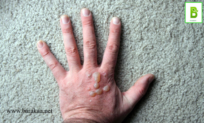 علاج الفقاعات الجلدية بالاعشاب