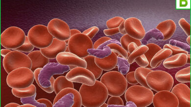 علاج فقر الدم الحاد بالاعشاب