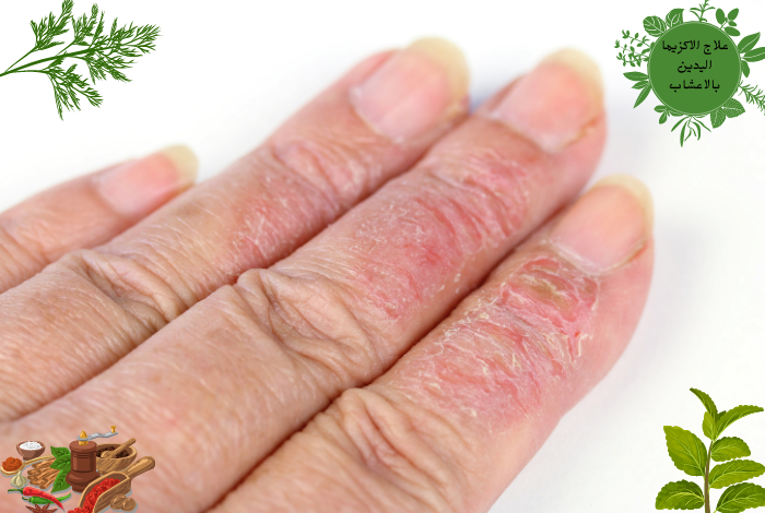 علاج الأكزيما في اليد بالأعشاب
