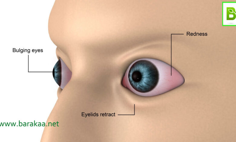 علاج جحوظ العين بسبب الغدة الدرقية بالاعشاب