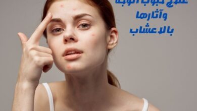 علاج حبوب الوجه وآثارها بالاعشاب