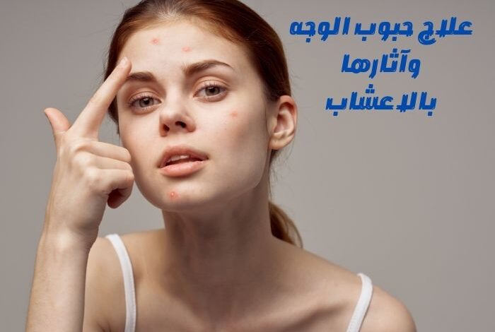 علاج حبوب الوجه وآثارها بالاعشاب