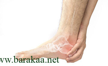 علاج مسمار القدم الداخلي
