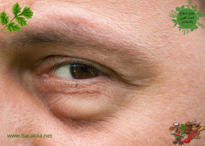 علاج انتفاخ تحت العين بالاعشاب تعرف على كيفية علاج انتفاخ تحت العين نهائيا