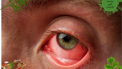 علاج التهاب ملتحمة العين بالاعشاب