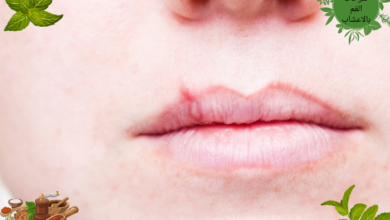علاج تقرحات الفم بالاعشاب