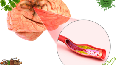 علاج الجلطة الدماغية بالاعشاب