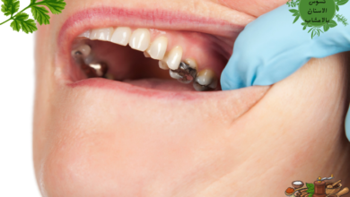 علاج تسوس الاسنان بالاعشاب