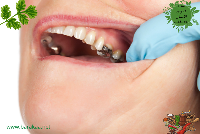 علاج تسوس الاسنان بالاعشاب