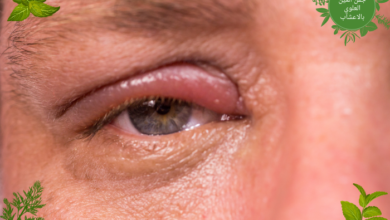 علاج التهاب جفن العين العلوي بالاعشاب