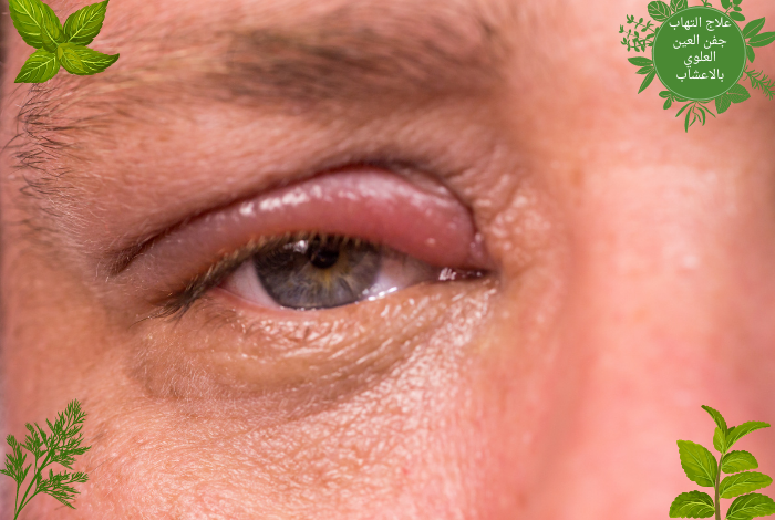علاج التهاب جفن العين العلوي بالاعشاب