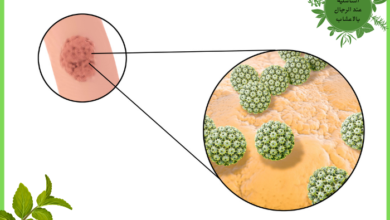 علاج الثآليل التناسلية عند الرجال بالاعشاب