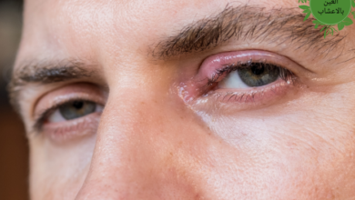 علاج دمل العين بالاعشاب