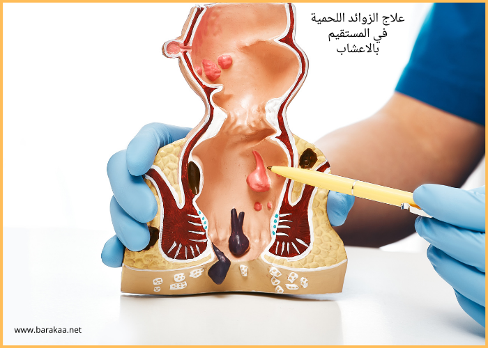 علاج الزوائد اللحمية في المستقيم بالاعشاب كيفية التخلص من الزوائد اللحمية نهائيا
