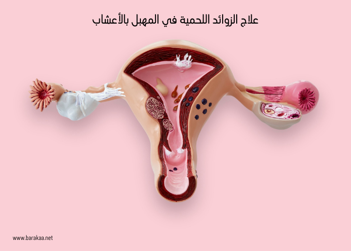 علاج الزوائد اللحمية في المهبل بالأعشاب كيفية استخدام الأعشاب في التخلص من الزوائد اللحمية نهائيا