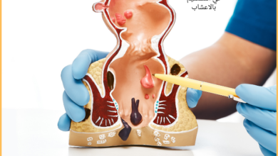 علاج الزوائد اللحمية في المستقيم بالاعشاب