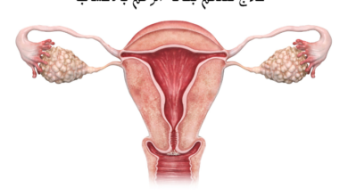 علاج تضخم بطانة الرحم بالاعشاب