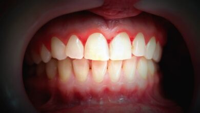 علاج انحسار اللثة وتخلخل الأسنان بالاعشاب